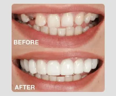 Snap-On Teeth Veneers Flexible Cosmetic Dentures for Men & Women